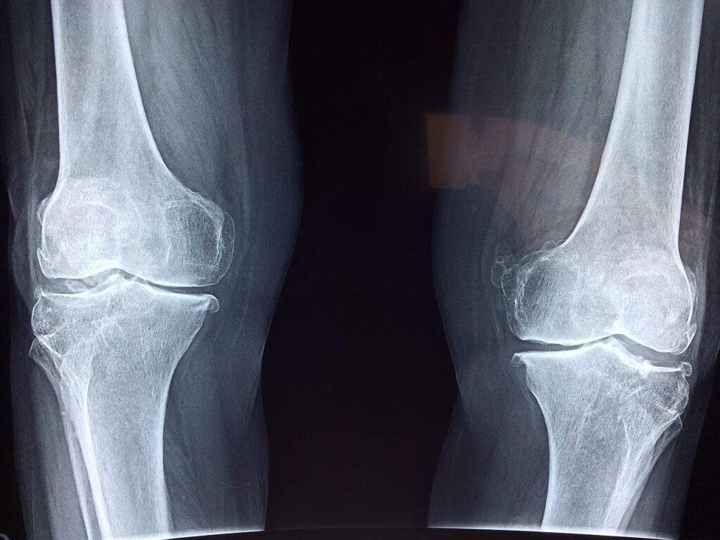 radiografia de rodillas